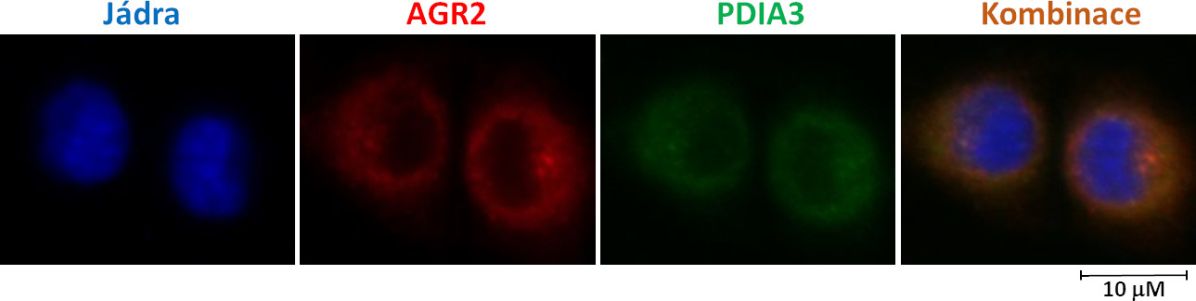 Ukázka lokalizace proteinů AGR2 a&nbsp;PDIA3 v&nbsp;nádorových buňkách A549 získaných z&nbsp;karcinomu plic pořízená pomocí fluorescenčního mikroskopu. 