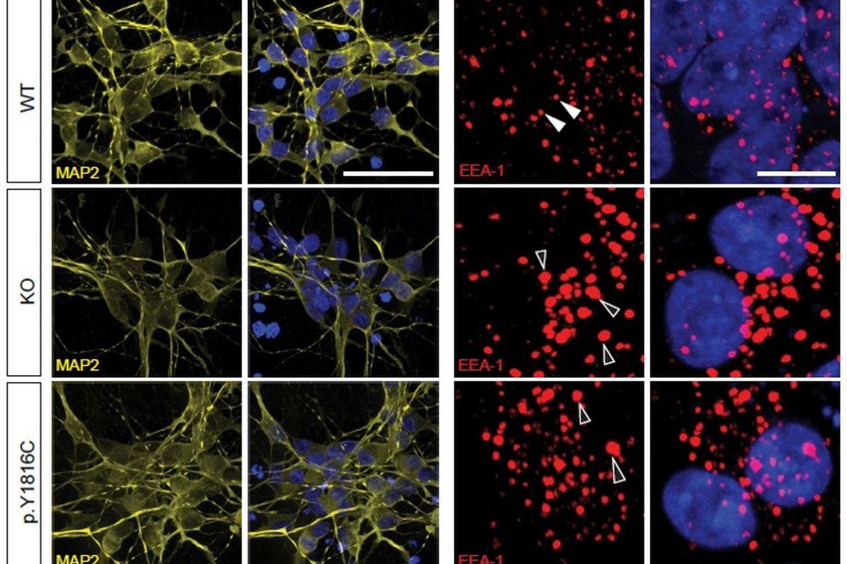 Zvětšené endozomy (červeně) u&nbsp;neuronů s&nbsp;mutací i&nbsp;u&nbsp;neuronů bez funkčního genu SORL1. Zvětšení endozomů je jedním z&nbsp;projevů, které mohou souviset s&nbsp;poruchou transportních procesů vedoucích k&nbsp;Alzheimerově chorobě.
