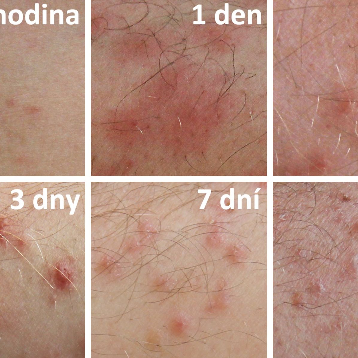 Typický průběh cerkáriové dermatitidy od počáteční expozice až po vyhojení. Nepříjemné projevy jsou nejintenzivnější prvních pět dní, poté ustupují. Počet a rozmístění jednotlivých pupínků zůstávají po celou dobu stejné, mění se pouze jejich vzhled. Každý pupínek obvykle odpovídá jedné proniknuvší cerkárii, která byla v kůži zachycena a zlikvidována imunitní reakcí hostitele. Autor: Jana Bulantová, PřF UK (CC BY-SA 4.0)